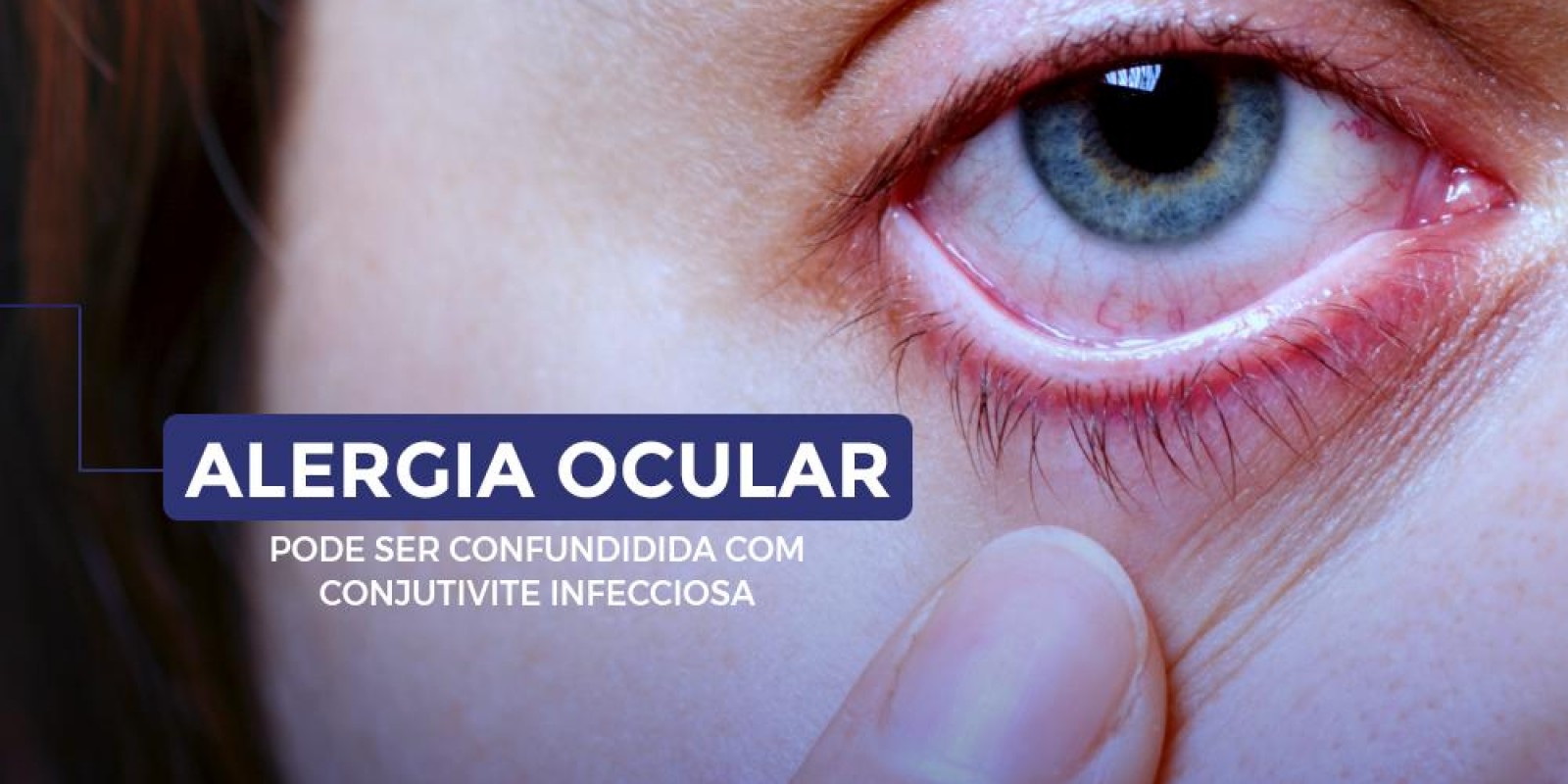 Alergia ocular X Conjuntivite Infecciosa