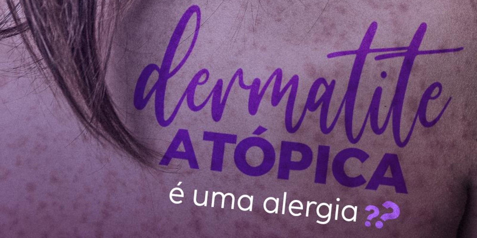 Dermatite atópica é uma alergia?